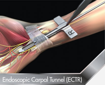 Endoscopic-Carpal-Tunnel-ECTR