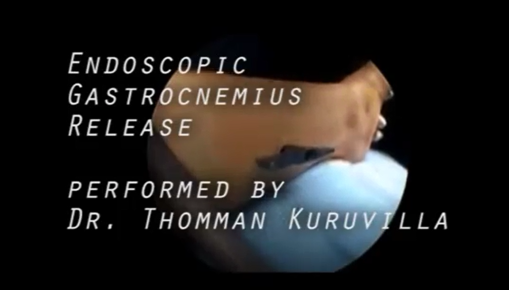 Endoscopic Cubital Tunnel Release (ECuTR) - Trice Medical